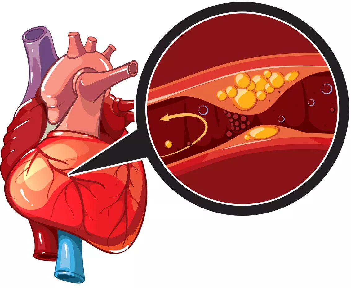 Coronary-disease-illustration.webp